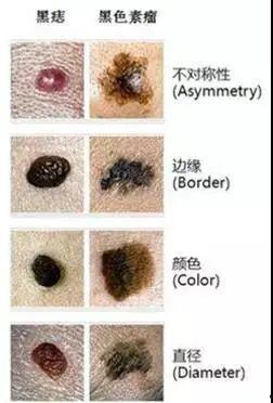 大黑痣图片,揭秘皮肤异样的神秘面纱